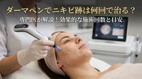ダーマペンでニキビ跡は何回で治る？