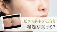 ピコスポット シミ取り 経過 写真って？