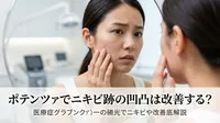 ポテンツァでニキビ跡の凹凸は改善する？